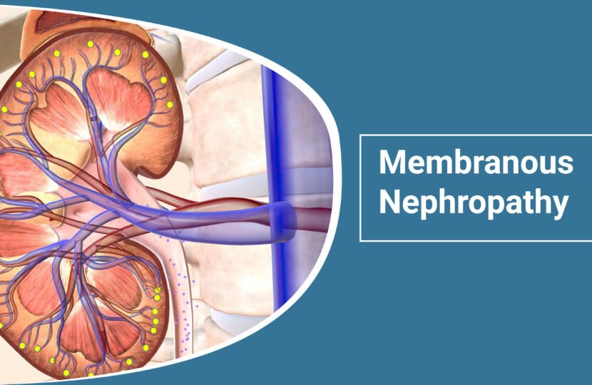 Membranous Nephropathy
