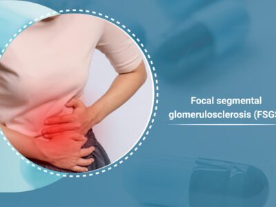 Focal Segmental Glomerulosclerosis (FSGS)