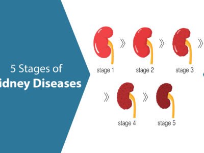 What are the 5 Stages of Kidney Diseases?