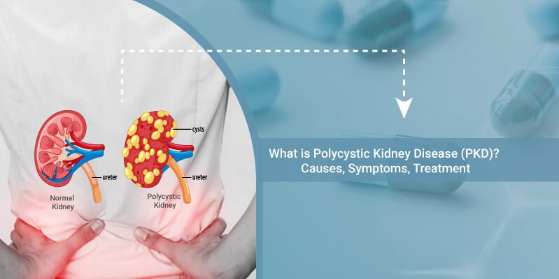 Polycystic-Kidney-Disease-causes-symptoms-treatment