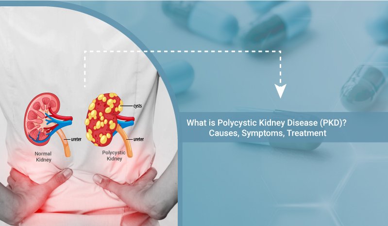 Polycystic-Kidney-Disease-causes-symptoms-treatment