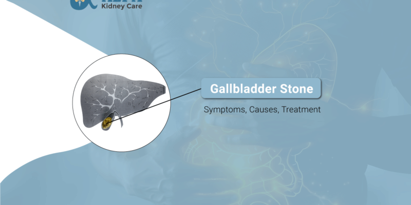 Gallbladder Stone Symptoms, Causes, Treatment
