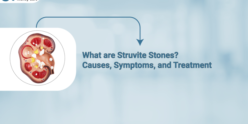 Struvite-Stone-causes-symptoms-treatment