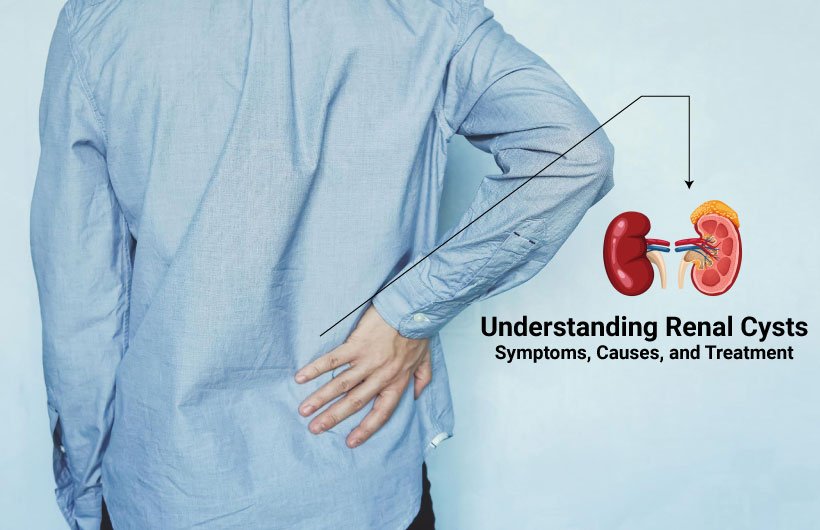 Understanding-Renal-Cysts-Symptoms-Causes-Treatment