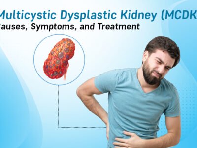 Understanding Multicystic Dysplastic Kidney (MCDK): Causes, Symptoms, and Treatment