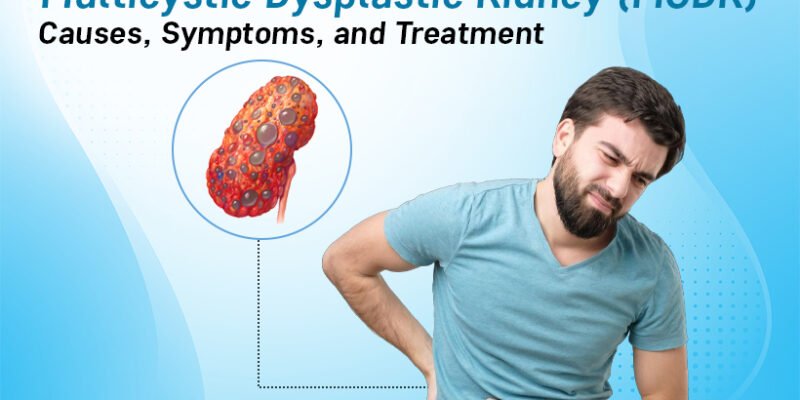 Multicystic Dysplastic Kidney (MCDK)