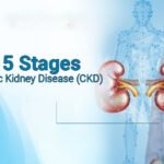 Stages of Chronic Kidney Disease