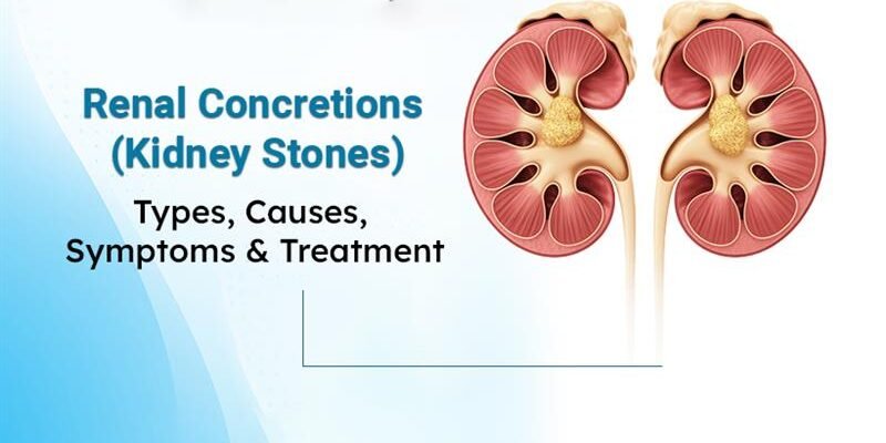 Renal Concretions Kidney Stones