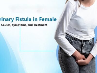 Urinary Fistula in Female: Causes, Symptoms, and Treatment