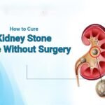 How to Cure Kidney Stone Without Surgery