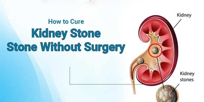 How to Cure Kidney Stone Without Surgery