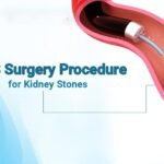 RIRS Surgery Procedure for Kidney Stones