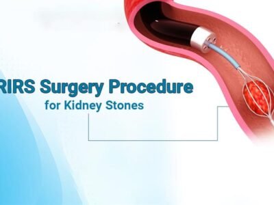 Understanding the RIRS Surgery Procedure for Kidney Stones