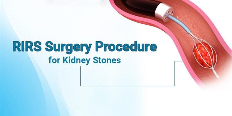 RIRS Surgery Procedure for Kidney Stones