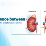 Difference between pyelonephritis and glomerulonephriti