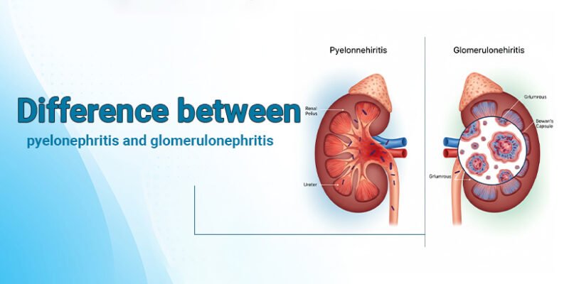 Difference between pyelonephritis and glomerulonephriti