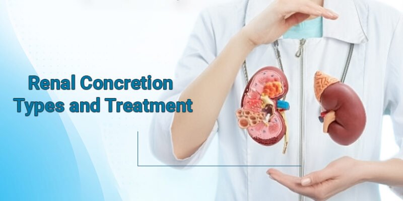 Renal Concretion Types and Treatment