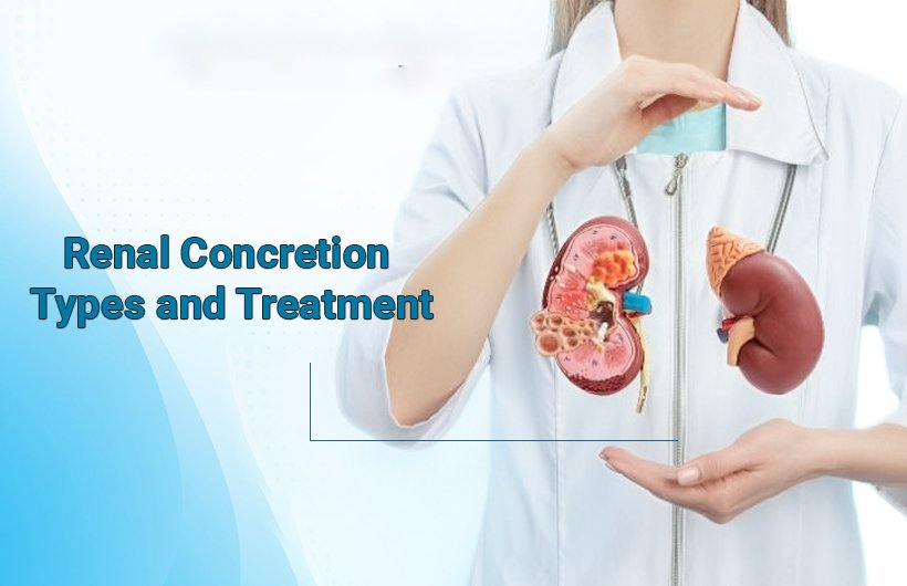Renal Concretion Types and Treatment