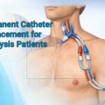 Permanent Catheter for Dialysis Patients