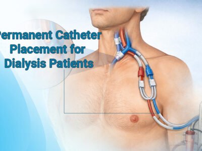 Permanent Catheter for Dialysis Patients