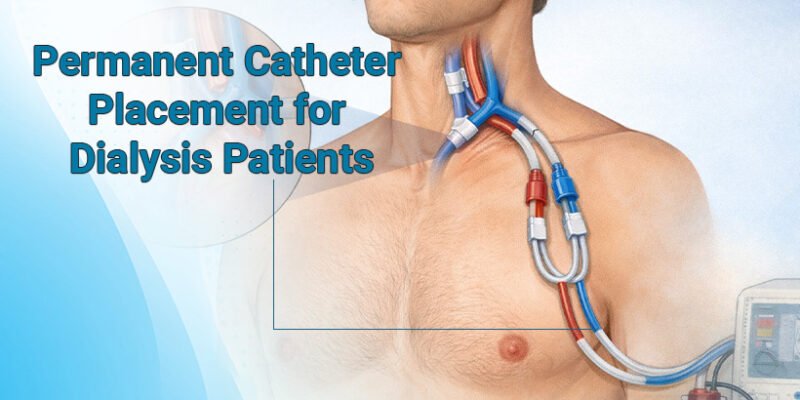 Permanent Catheter for Dialysis Patients