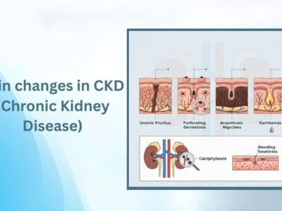 Skin changes in CKD(Chronic Kidney Disease)