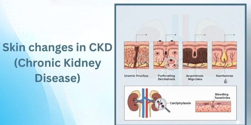 Skin changes in CKD