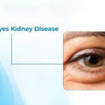 Puffy eyes kidney disease