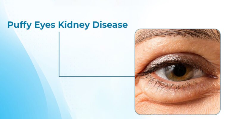 Puffy eyes kidney disease
