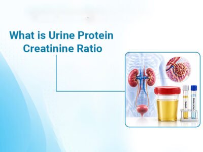 Urine Protein Creatinine Ratio: Normal Range, Meaning, Causes & Treatment