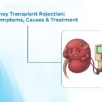 Kidney Transplant Rejection Treatment In Ahmedabad