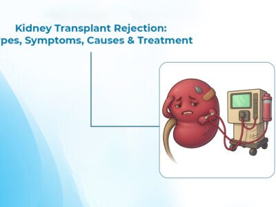 Kidney Transplant Rejection: Types, Symptoms, Causes & Treatment